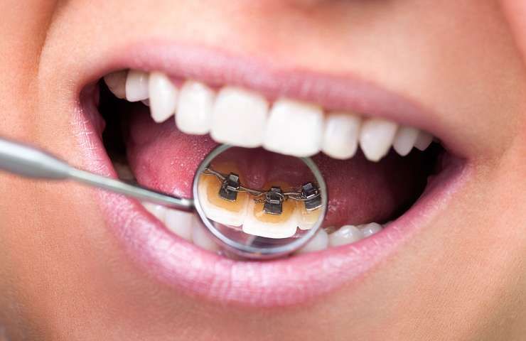 Invisalign® at Churchill Glen Dental, Mississauga