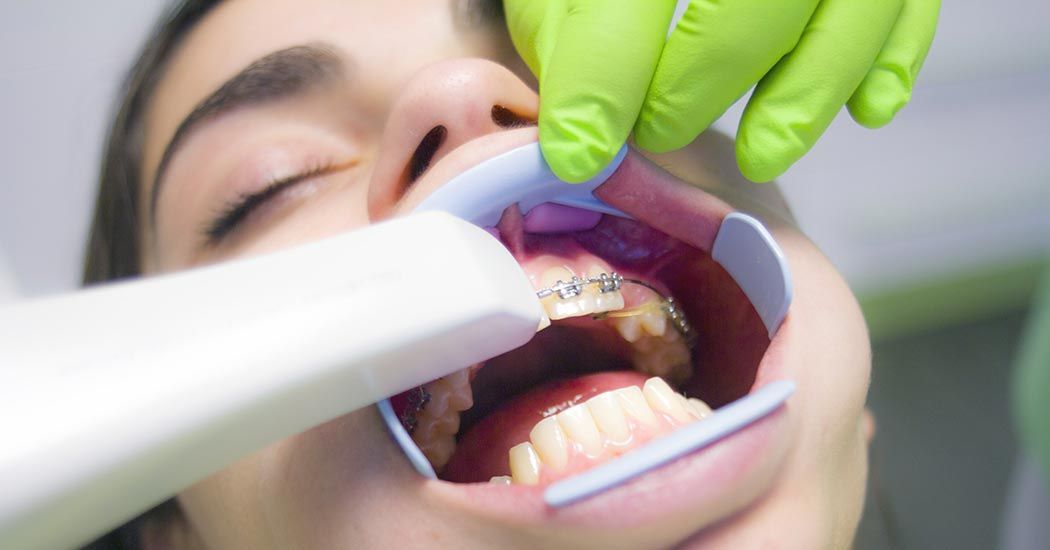 Veneers at Churchill Glen Dental, Mississauga